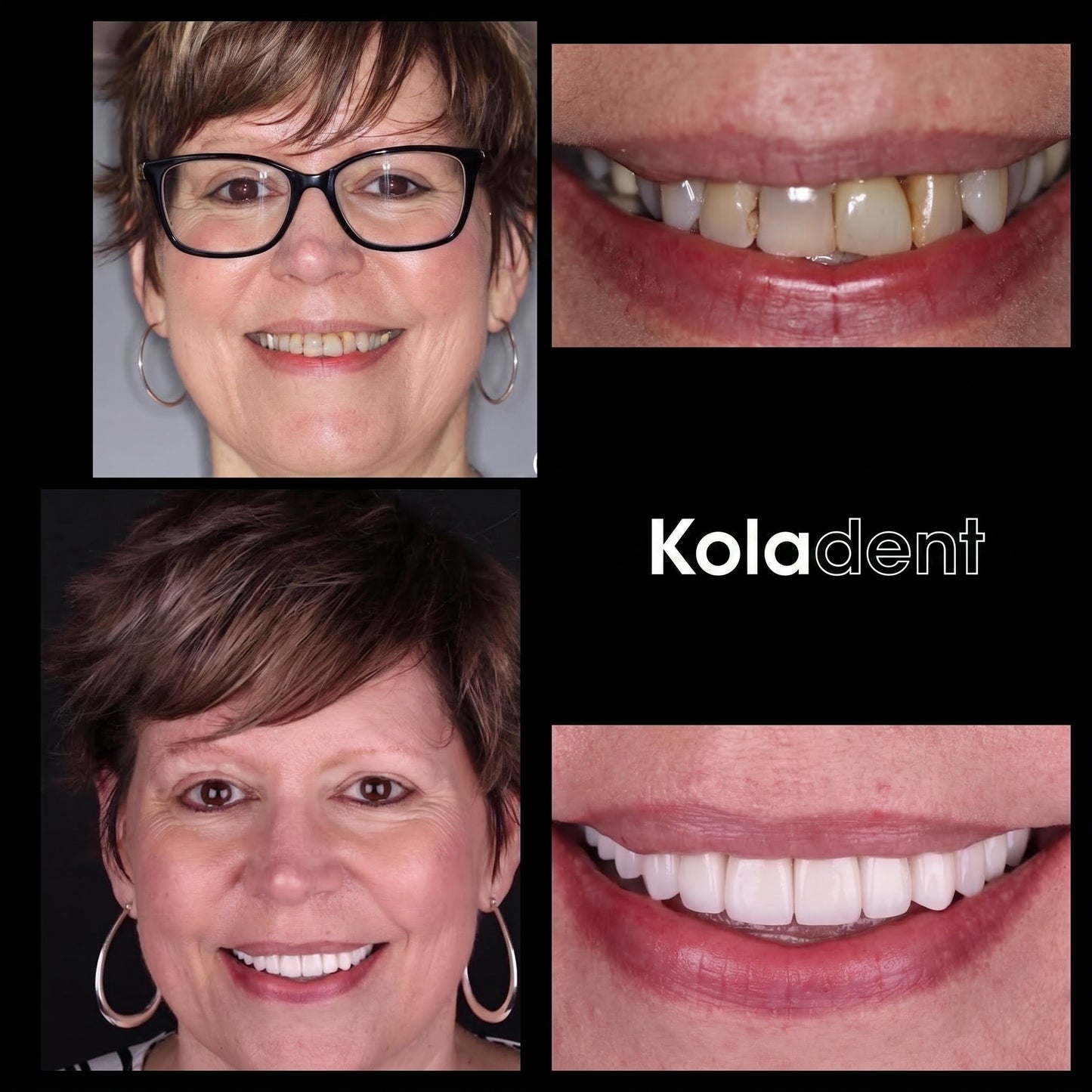 Kit de blaqueamiento dental