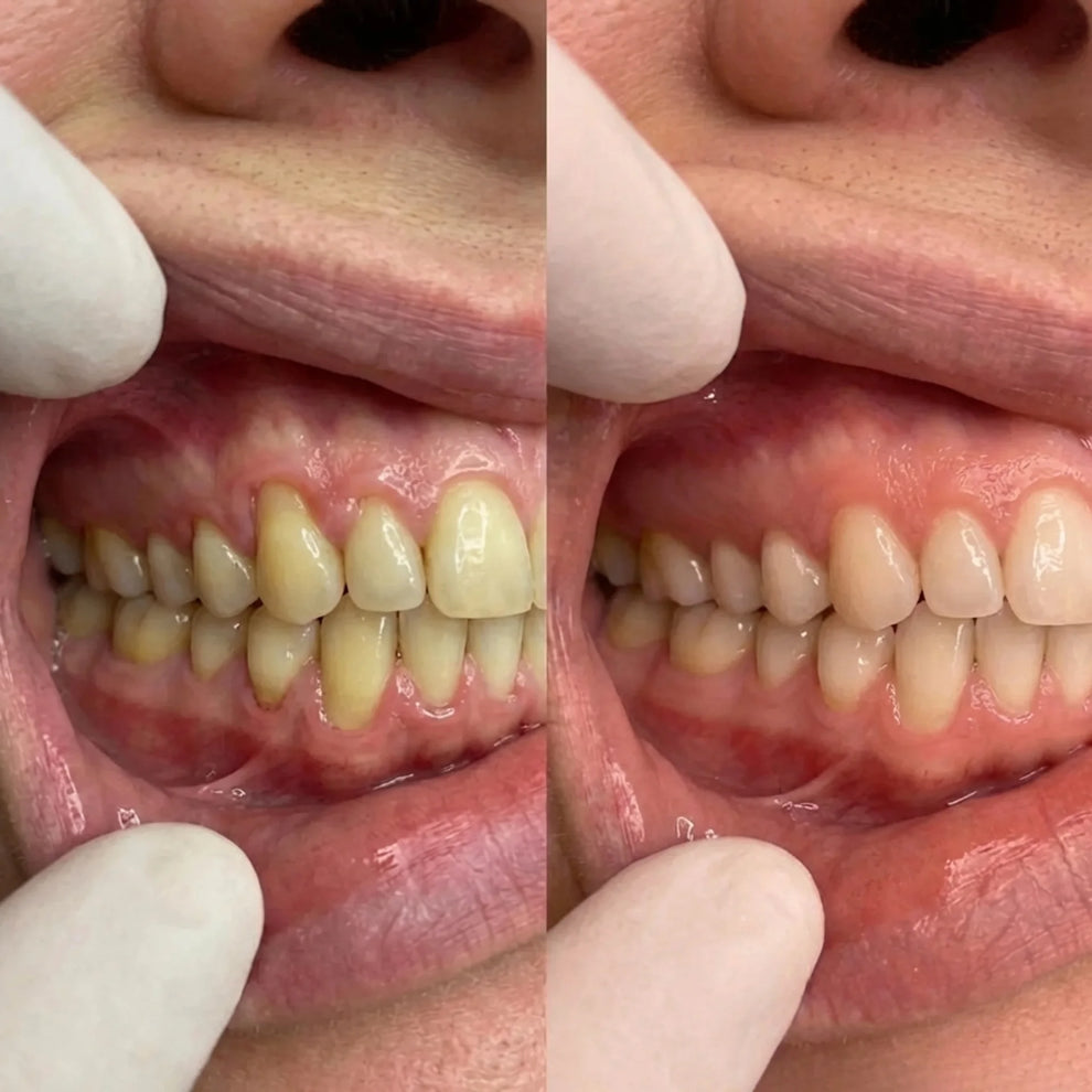 CollaGum™ - Firmer Gums Without Surgery