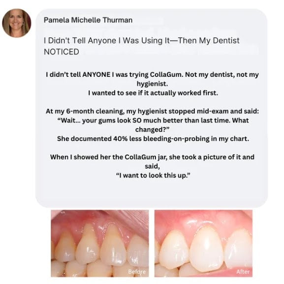 CollaGum™ — Firmer Gums Without Surgery