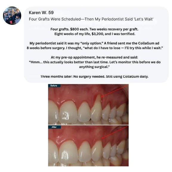 CollaGum™ — Firmer Gums Without Surgery