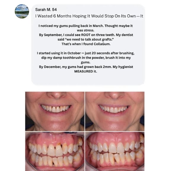 CollaGum™ — Firmer Gums Without Surgery