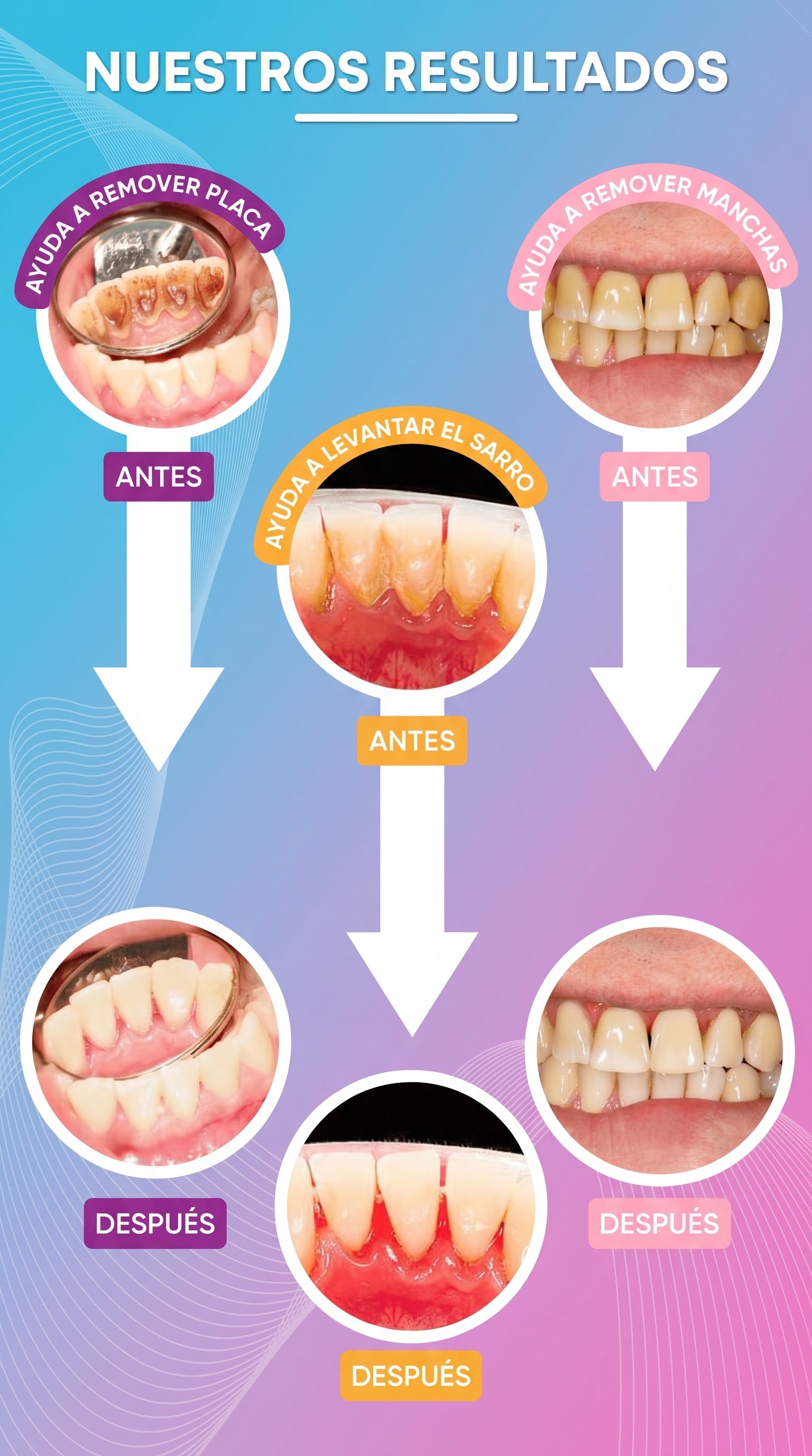 Limpiador Dental Ultrasónico